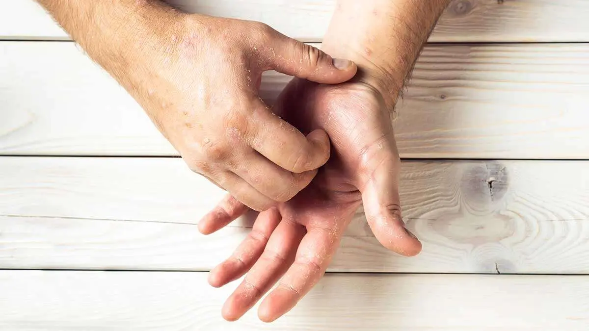 psoriasis