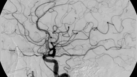 Angiograma Cerebral