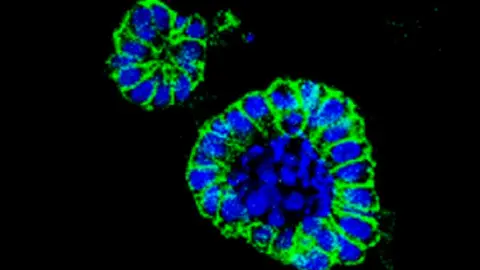organoide de c&aacute;ncer de colon