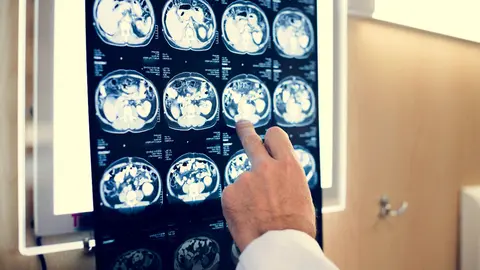 placa alzheimer